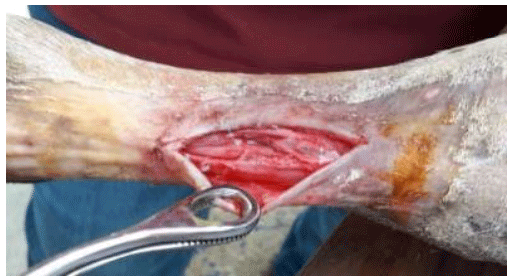 Figura 3. Incisión de piel y fascias para acceder a los tendones flexores digitales superficial y profundo