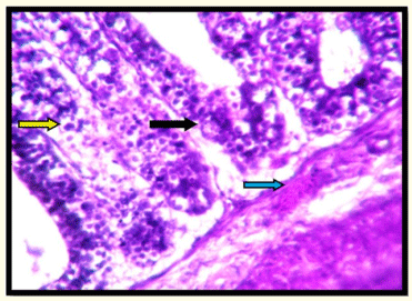 Figura 5: Grupo de control desafiado: Fotografía que muestra necrosis de las células epiteliales (flecha negra), gametocitos de coccidias (flecha amarilla), infiltración de leucocitos (flecha azul) Tinción H y E 400 X.
