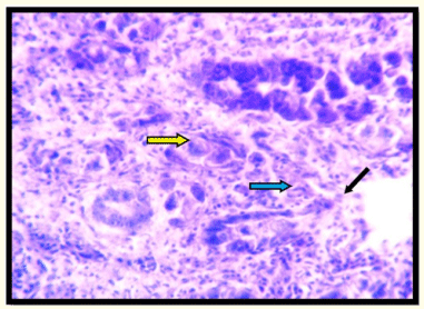 Figura 7: Grupo Biococcin 500: Fotografía que muestra necrosis de células epiteliales (flecha negra), gametocitos de coccidias (fila amarilla), infiltración de leucocitos (flecha azul) Tinción H y E 400 X.