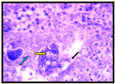 Figura 8: Grupo Monensin: Fotografía que muestra necrosis de células epiteliales (flecha negra), gametocitos de coccidias (fila amarilla), infiltración de leucocitos (flecha azul) Tinción H y E 400 X.