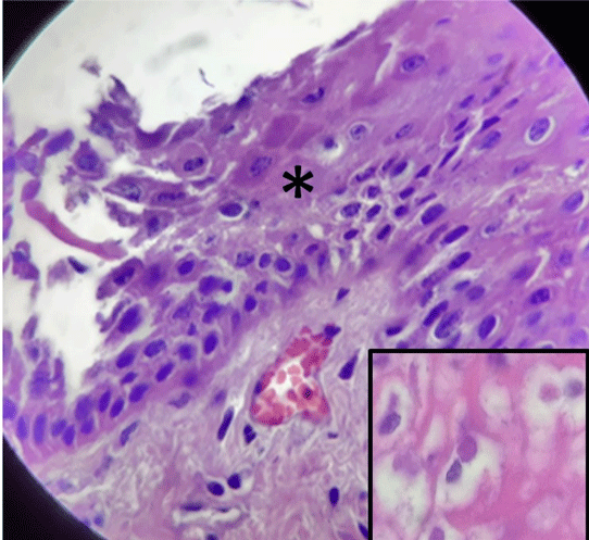 Figura 3 Leve hiperemia, núcleos retraídos y necrosis celular de capas superficiales de epidermis (*), con estructuras acidófilas compatibles con cuerpos de inclusión intracitoplasmáticos (recuadro).