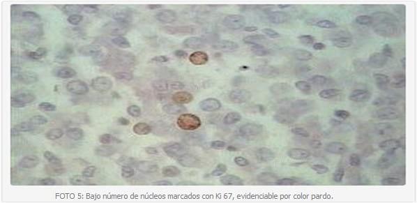 Neoplasias melanocíticas en caninos, medición de la actividad de proliferación celular mediante la inmunoreactividad de antígeno Ki67. Informe preliminar. - Image 3