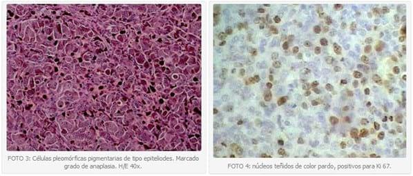 Neoplasias melanocíticas en caninos, medición de la actividad de proliferación celular mediante la inmunoreactividad de antígeno Ki67. Informe preliminar. - Image 2