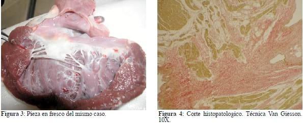 Miocardiopatía por exceso de falsos tendones en el ventrículo izquierdo; hacia la caracterización de una nueva entidad nosológica: 7 casos. - Image 1