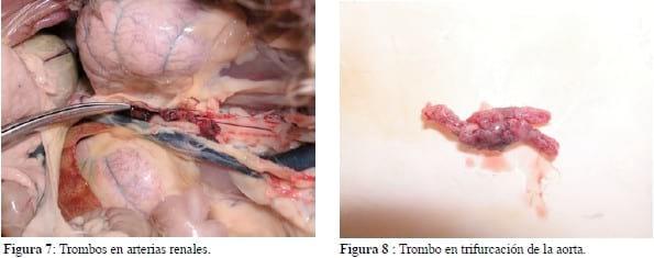 Miocardiopatía por exceso de falsos tendones en el ventrículo izquierdo; hacia la caracterización de una nueva entidad nosológica: 7 casos. - Image 3