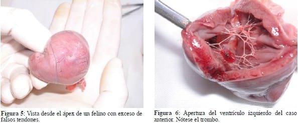 Miocardiopatía por exceso de falsos tendones en el ventrículo izquierdo; hacia la caracterización de una nueva entidad nosológica: 7 casos. - Image 2