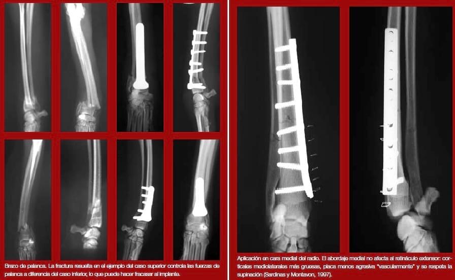 Complicaciones de fracturas reparadas con placas y tornillos - Image 4