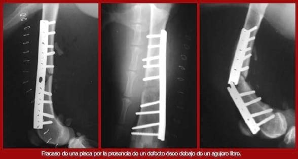Complicaciones de fracturas reparadas con placas y tornillos - Image 9