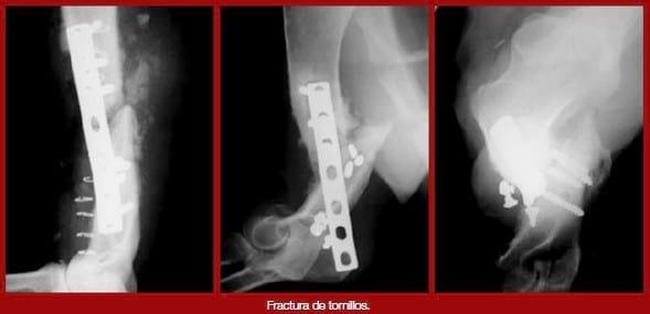 Complicaciones de fracturas reparadas con placas y tornillos - Image 8