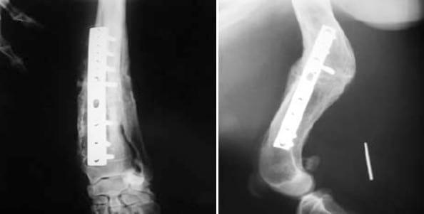 Complicaciones de fracturas reparadas con placas y tornillos - Image 12
