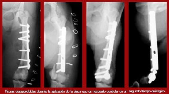 Complicaciones de fracturas reparadas con placas y tornillos - Image 10