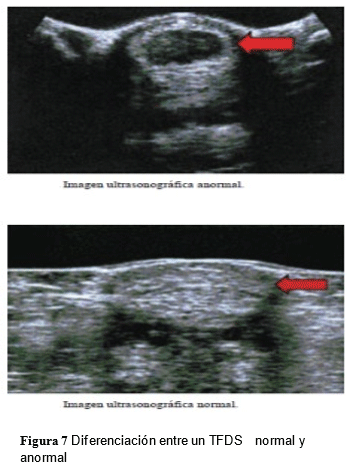 Tendinopatías del tendón flexor digital superficial: diagnóstico y tratamientos - Image 7