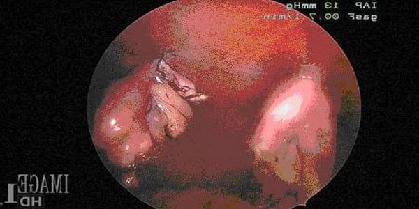 Ovariectomía laparoscópica: una alternativa mínimamente invasiva para la esterilización. - Image 2