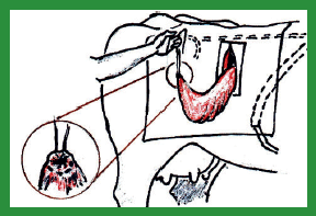 Manual de anestesias y cirugías de bovinos: Cirugías de Abdomen - Image 55