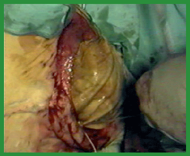 Manual de anestesias y cirugías de bovinos: Cirugías de Abdomen - Image 62
