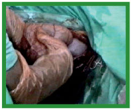 Manual de anestesias y cirugías de bovinos: Cirugías del aparato reproductor de la hembra - Image 5