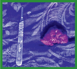 Manual de anestesias y cirugías de bovinos: Cirugías aparato reproductor del macho - Image 35