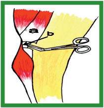 Manual de anestesias y cirugías de bovinos: Cirugías de las extremidades - Image 25