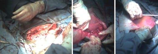 Reporte de caso clínico: Hernia incisional - Image 5