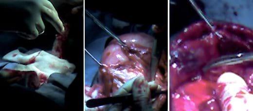 Reporte de caso clínico: Hernia incisional - Image 4