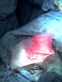 Reporte de caso clínico: Hernia incisional - Image 6