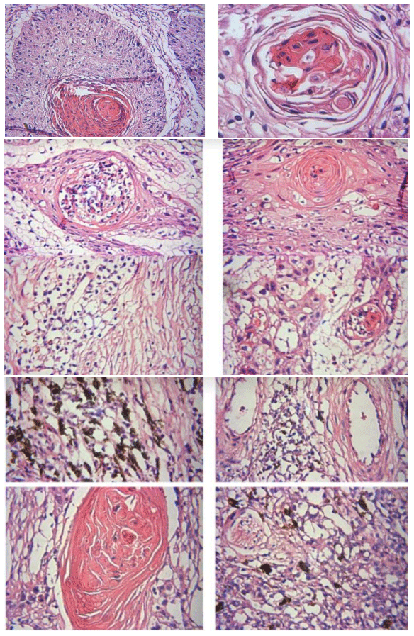 Figura 2. Aspecto microscópico de tumores oculares, con zonas de cornificación y queratinización (perlas de queratina) (a), configurando estructuras eosinófilas concéntricas de queratina, de aspecto redondeado con infiltrado linfocítico en el centro de dichas estructuras. Asimismo, se observan zonas con abundantes melanocitos (b) y neoformación vascular.