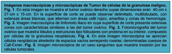 Tumor de células de la granulosa maligno en una vaca holstein. - Image 3