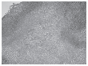 Figura 2: Área extensa de necrosis coagulativa, rodeado por una corona de neutrófilos y hemorragia H&E 40X.