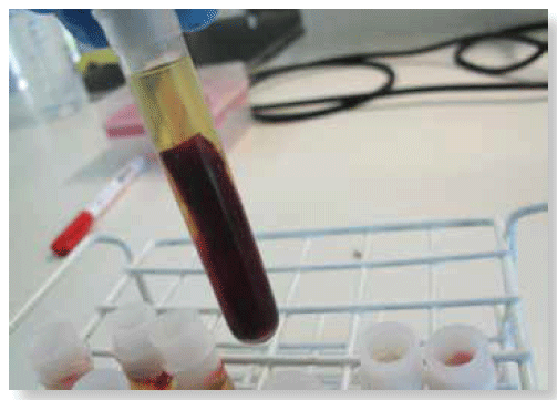 Separación del suero y el coágulo de la sangre