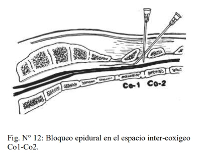 Obstetricia y neonatología bovina: VII. Anestesias en obstetricia - Image 1