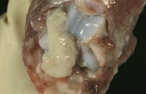 onfaloflebitis