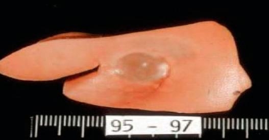 Cysticercus Cellulosae en carne de cerdos, Técnicas para eliminarlo - Image 17