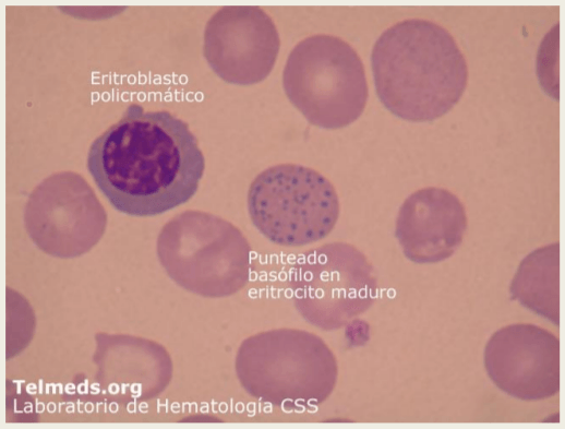Intoxicación por plomo - Image 10
