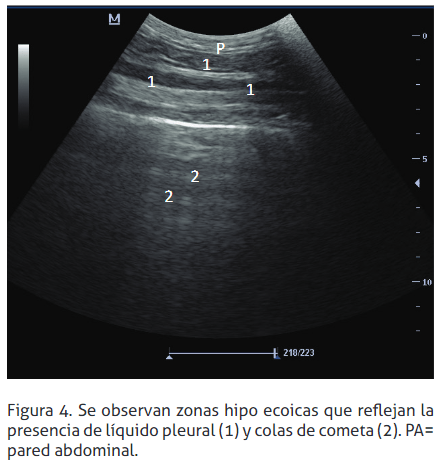 Reticulopericarditis traumática: reporte de un caso - Image 4