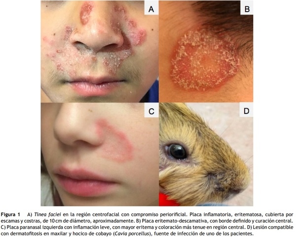 richophyton benhamiae, un dermatofito zoofílicoemergente en Argentina con reservorio en cobayos: Descripción de 7 casos en un hospital de la CiudadAutónoma de Buenos Aires - Image 1