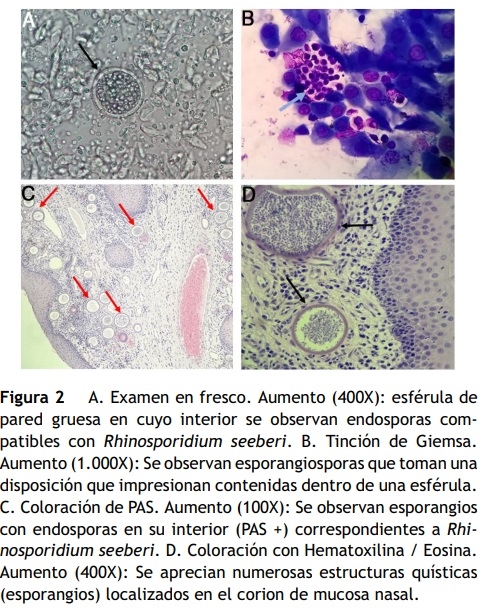 Rinosporidiosis por Rhinosporidium seeberi en un canino de Argentina - Image 2