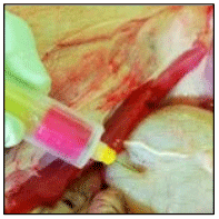 Figura 5. Toma de muestra estéril de orina en tubos sin anticoagulante.