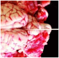 Figura 7. En caso de sospecha de meningitis, se pueden tomar muestras del tercer ventrículo con hisopos para estudios microbiológicos.