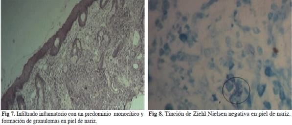 Caso clínico: Utilización del Bacillus Calmette-Guerín en carcinoma de células escamosas en una gata doméstica y posterior estudio histopatológico. - Image 4