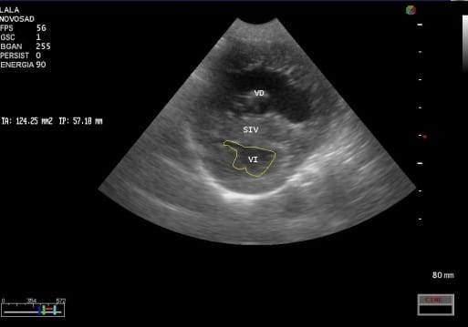 Caso Clínico: Tetralogia De Fallot - Image 1