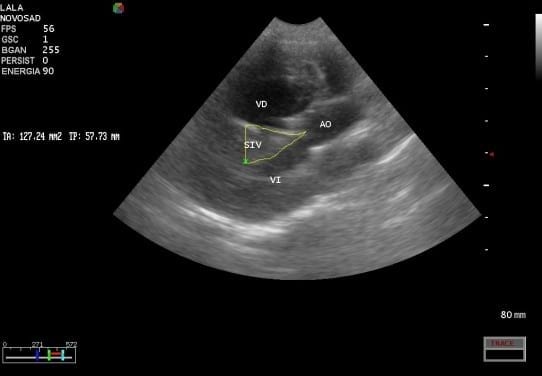 Caso Clínico: Tetralogia De Fallot - Image 2