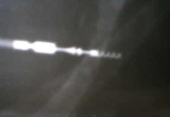 Bloqueo AV completo en un perro y resolución con implantación de un marcapasos - Image 6