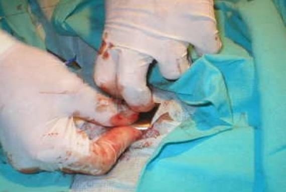 Bloqueo AV completo en un perro y resolución con implantación de un marcapasos - Image 4