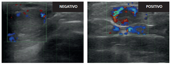 Figura 3. Evaluación de la perfusión sanguínea del cuerpo lúteo por ultrasonografía Doppler en modo Color. Cuerpo lúteo de una vaca vacía clasificado como negativo (izquierda). Cuerpo lúteo clasificado con perfusión positiva en una vaca preñada (derecha).