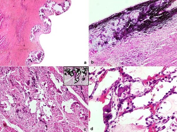 Duraznillo Blanco: Análisis detallado de 23 brotes de Calcinosis Enzoótica y el desafío del 