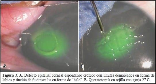 Defecto epitelial corneal espontáneo crónico en perros. - Image 3