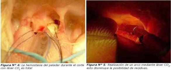 Resolución quirúrgica mediante láser CO2 del síndrome respiratorio braquicefálico en gatos - Image 3