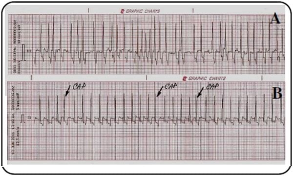Utilidad de la electrocardiografía en la clínica veterinaria de animales de compañía - Image 5