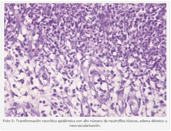 Vasculitis Leucocitoclástica en un Cachorro Scottish Terrier. - Image 5