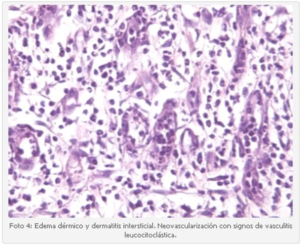 Vasculitis Leucocitoclástica en un Cachorro Scottish Terrier. - Image 4